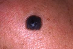 Up to 20% are metastatic; 99% of in situ cases are not recurrent.
Various appearances: Raised, brown to black and rapidly appearing, growing papules which may suggest a vascular lesion and may have focal hemorrhage.
Rx: Wide surgical excision, elective 