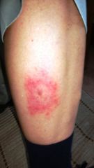 Erythema migrans involving spontaneously fading central erythema leaving light blue surface. Ring remains flat, blanches with pressure, does not desquamate and the erythema migrans border may be slightly raised.
Rx: Doxycycline, Amoxicillin.