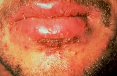 Thin roofed bullae,flat honey colored crusts are seen. Highly contagious!!
Rx: Topical anti-staph agents e.g. mupirocin or fusidic acide may be effective  and used prior to consideration of starting po agent