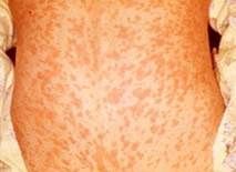 Erythematous, nonpruritic, maculopapular rash is seen spreading on the trunk. Brownish discoloration of skin may occur later.
Rx: supportive, symptom based. Vitamin A for severe measles.