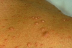 Thin walled clear umbilicated vesicle and simultaneous presence of other lesions (vesicles, pustules, crusts).
Rx: Supportive care if low risk, immunocompromised, Otherwise consider Acyclovir