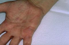 CAN BE FROM POISON IVY OR WHATEVER

Erythema ,dryness, and vesicles are seen.

Rx: Topical glucocorticoids (FOR HANDS NEED GLOVES), Avoidance of irritants

IF HANDS ASK ABOUT GENITALIA (COULD DEVELOP CELLULITIS IF SCRATCH)