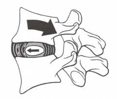 Vértebra superior se desplaza hacia atrás
 Espacio intervertebral posterior disminuye
 Núcleo se desplaza hacia delante
 Tensión en fibras anteriores del anillo fibroso