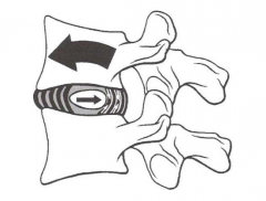 Vértebra superior se desliza hacia delante
  Espacio intervertebral anterior disminuye
  Núcleo se desplaza hacia atrás
  Tensión en fibras posteriores del anillo fibroso