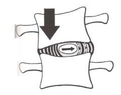 Vértebra superior se hacia lado de la inclinación
 Núcleo se desplaza hacia lado de la convexidad
 Tensión en fibras de la convexidad del anillo fibroso