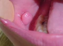 - fibrous overgrowth on lip/cheek/tongue
- quite pale
- covered in keratinised epithelium