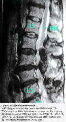 - MRT, CT(-Myelographie)
→ Kompression von Spinalnerven 
→ Nachweis von Osteophyten