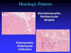 1. Dermatomyositis: Abnormal muscle fibers are usually grouped in one portion of the fascicle, suggestive of microinfarction mediated by blood vessel dysfunction
vs. Polymyositis: In contrast to DM, abnormal necrotic and regenerating muscle fibers...
