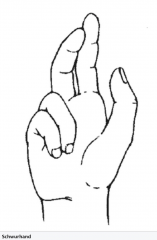 - Schwurhand: Ausfall der Flexoren von Daumen, Zeige-, und Mittelfinger  → Faustschluss nicht mehr möglich
- Thenarmuskelatrophie
- Sensibilitätsstörungen an der radialen Handinnenfläche  und den dorsalen Fingerkuppen des Daumens, Zeigefinge...