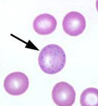 

 These dots are the visualization of ribosomes and can often be found in the peripheral blood smear, even in some normal individuals.[1]

It is associated with several conditions, including:
Myelodysplastic Syndrome
Sideroblastic anemia
Lead...