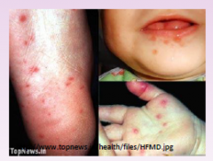 Hand-Foot-and Mouth Disease (Coxsackie virus A16)

