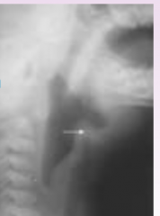 Epiglottitis

mc bug = H. flu (unimmunized). (other = strep pyo, strep pneumo, staph)

x-ray buzzword = "tumbprint sign"

next best step = go to OR and intubate

Tx = anti-staph abx + 3rd gen. cephalosporin
