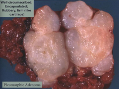 - Most common salivary gland tumor
- Well circumscribed and encapsulated
- Rubbery, firm (like cartilage)

Benign Mixed Tumor:
- Epithelial cells (ductal)
- Myoepithelial cells
- Mesenchymal components: myxoid, hyaline, chondroid

Pleomor...