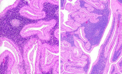 - Papillary cystic change
- Bilayered oncocytic (pink) epithelial cells (= oncocytes) and lymphocytes