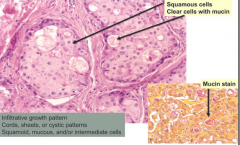 Mixture of squamous, mucous, and intermediate cells
- Infiltrative growth pattern
- Cords, sheets, or cystic growth patterns