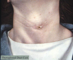 - Occurs prior to 4th decade
- Midline, connected to hyoid bone