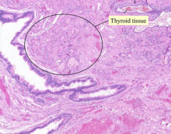 - Lined by respiratory or squamous epithelium
- Thyroid tissue in wall of cyst