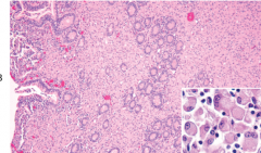 What are the pale pink cells in this image (enlarged in the corner) and what type of inflammation are they associated with?