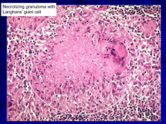 Granulomatous inflammation w/ necrosis:
- Epithelioid histiocytes
- Multinucleate giant cells
- Lymphocytes
- Macrophages

Bacteria found in necrotic material