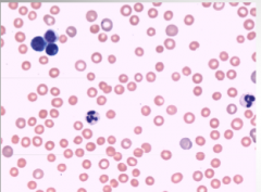 Given that this is a blood smear what is abnormal about it and what is this indicative of?