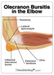 located in tissue over the olecranon


injury due to repeated excessive friction (="student's elbow")
