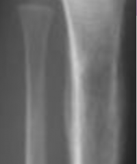 Ewing Sarcoma (typically affects the middle of long bones)

If <10, more likely. M>F. More common if hx of retinoblastoma or previous radiation. “Onion skinning” on xray. (layers of periosteal development). 

–Treatment? Rads and/or surgery