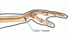 distal radial fracture = Colles' fracture


MOI = FOOSH