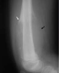Osteogenic sarcoma (typically the end of long bones)
If >10, more likely. M>F. See “sunburst” and “Codman’s triangle” on xray.

tx = Chemo and/or surgery 