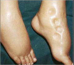 What is this type of edema called and what tissue layer is the fluid in?