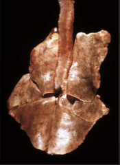 What causes this colouring of the lungs?