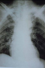 Pulmonary Histoplasmosis 
- Multiple calcified lesions
- Probably had the disease a while back
- Disseminated infiltrates to both sides of lungs

* This is not diagnostic on its own, but with appropriate history