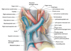 A PVT Left BATTLE
Arch of Azygos
Phrenic n.
Vagus n.
Thoracic duct
Left Laryngeal n. (only L)
Brachiocephalic vein & SVC
Arch of Aorta (Brachiocephalic trunk, L common carotid artery, L subclavian artery)
Thymus
Trachea
Lymph
Esophagus