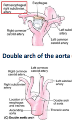 1. Retroesophageal right subclavian a. - The R subclavian artery crosses posterior to the esophagus. 
2. DAA- double arch aorta (in cardio lec) Vascular ring anomaly. Ring around esophagus and trachea; congenital anomaly. Sx: Stridor (high pitched...