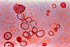 Coccidioides spherules - they burst and release endospores