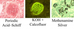 - Periodic Acid-Schiff
- KOH+ Calcofluor
- Methenamine Silver