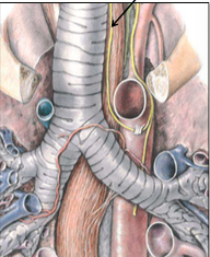 Injury to recurrent laryngeal nerves