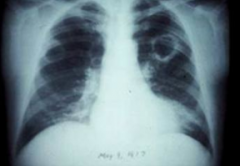 Cavitation in pulmonary Coccidioidomycosis