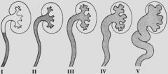 1. predisposition to pyelonephritis
2. scarring
3. reflux nephrology (HTN, proteinuria, renal insuff to ESRD)
4. impaired kidney growth
dx = VCUG