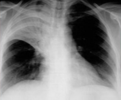 Case: 38 yo MKE man developed low grade fever, myalgias, and non-productive cough. Crackles over R posterior chest. Patient had no travel hx, no animal exposure, no HIV risk, worked clearing land for transmission lines.

Given oral erythromycin ...