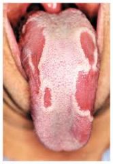 Lesion that appears as red and then paler pink to white patches on tongue.