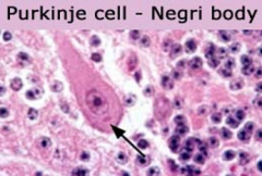 perkinje cell--Rhabdovirus(Rabies)