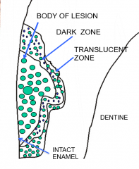 1) Translucent zone
2) Dark zone = increase porosity, small holes inaccessible to imbibing fluid
3) Body of lesion = more porosity, large pores.