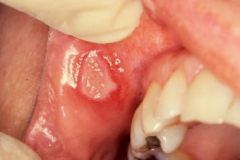 -shape: oval/irregular-size: >10mm
-number: <5 at a time (esp soft palate)
-mucosa affected: keratinising OR non-keratinising
-duration: heal 6-12 wks
-outcome: Heal with/without scarring