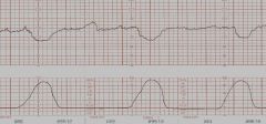 Decelerations in the fetal heart rate the begin and end at the same time as the contractions


 


This indicates fetal head compression during a contraction
