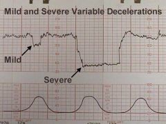Decelerations of the fetal heart rate that occur at anytime related to contractions. Tend to be precipitous drops. 


 


This indicates umbilical cord compression