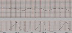 Deceleration of the fetal heart rate that occur at the peak of a contraction and slowly return to baseline after the contraction is completed


 


Most worrisome type of deceleration as this indicated uteroplacental insufficiency. This indicates...