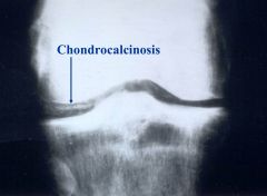 chondrocalcinosis