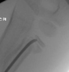 radial neck fracture with greater than 45 degrees of residual angulation following closed reduction. The majority of pediatric radial neck fractures can be treated with closed reduction. Up to 30 degrees of angulation is considered acceptable. Gre...