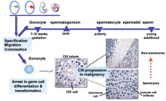 Gonocytes
arrest in their potential to differentiate and become completely resistant to the surrounding tissues that tell them to start spermatogenesis. There is progression into malignancy and tumours will start to grow. can result in seminoma o...