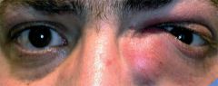 Clinique : Signes de l'inflammation (tumor, rubor calor) localisés au bord interne de l'oeil
Complication : Cellulite orbitaire